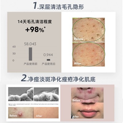 袪痘仪袪斑仪美容净肤仪美容仪粉刺痤疮美肤仪嫩肤仪等离子美容仪图5