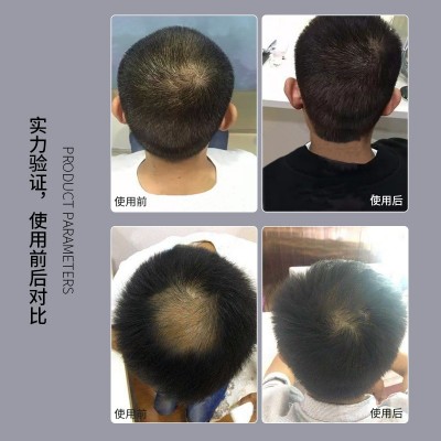 头发理疗仪护发仪养发护发头皮抗衰检测毛囊清洁头皮导入仪头疗仪图4
