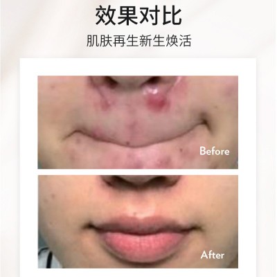 等离子激光技术三档可调节脸部电动祛痘除螨仪 脸部嫩肤美容仪图4