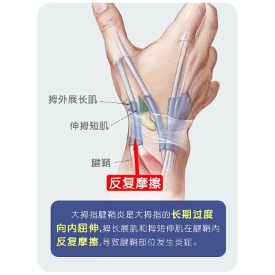 大拇指扭伤护指护腕康复超薄腱鞘鼠标妈妈手拇指劳损护套关节护套图2